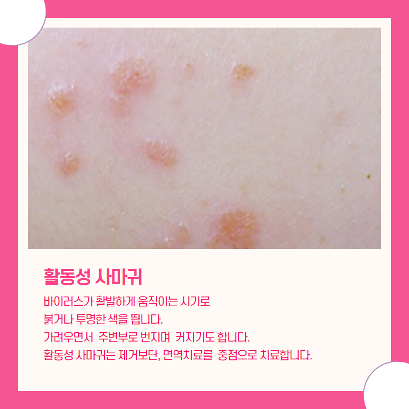 활동성 편평사마귀 안내 그림, 붉거나 투명한 색을 띠고 가려우면서 주변으로 번질 수 있어 면역치료를 중심으로 치료한다는 설명