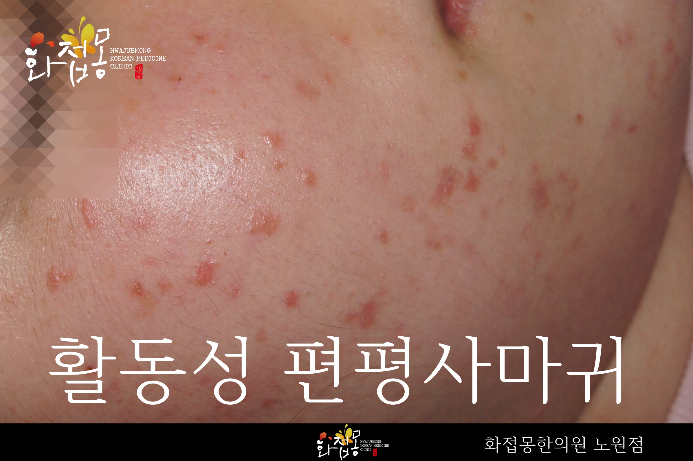화접몽한의원 노원점에서 촬영한 활동성 편평사마귀 사진, 볼에 붉게 부풀어 오른 작은 발진이 흩어져 있는 모습