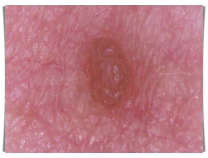 확대해서 본 편평사마귀 병변, 피부 위로 살짝 솟은 작은 돌기