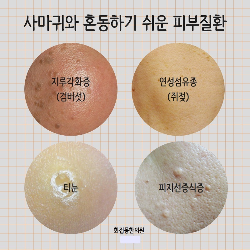 사마귀와 혼동하기 쉬운 피부 질환인 지루각화증(검버섯), 연성섬유종(쥐젖), 티눈, 피지샘증식증의 확대 사진