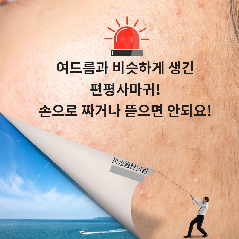 여드름과 비슷하게 생긴 편평사마귀를 손으로 짜거나 뜯지 말라는 안내 그림