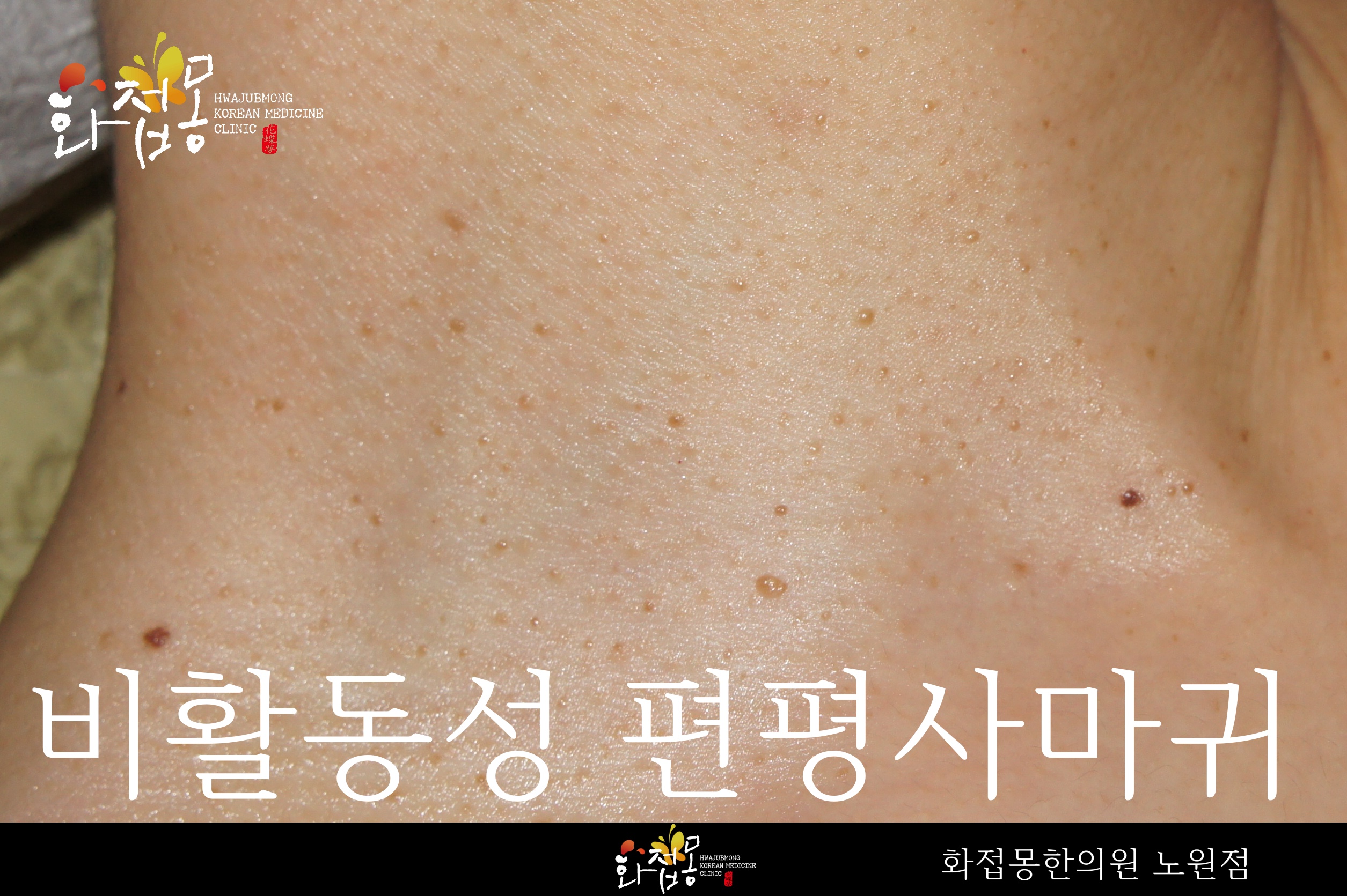화접몽한의원 노원점에서 촬영한 비활동성 편평사마귀 사진, 갈색의 납작한 돌기가 여러 개 퍼져 있는 모습