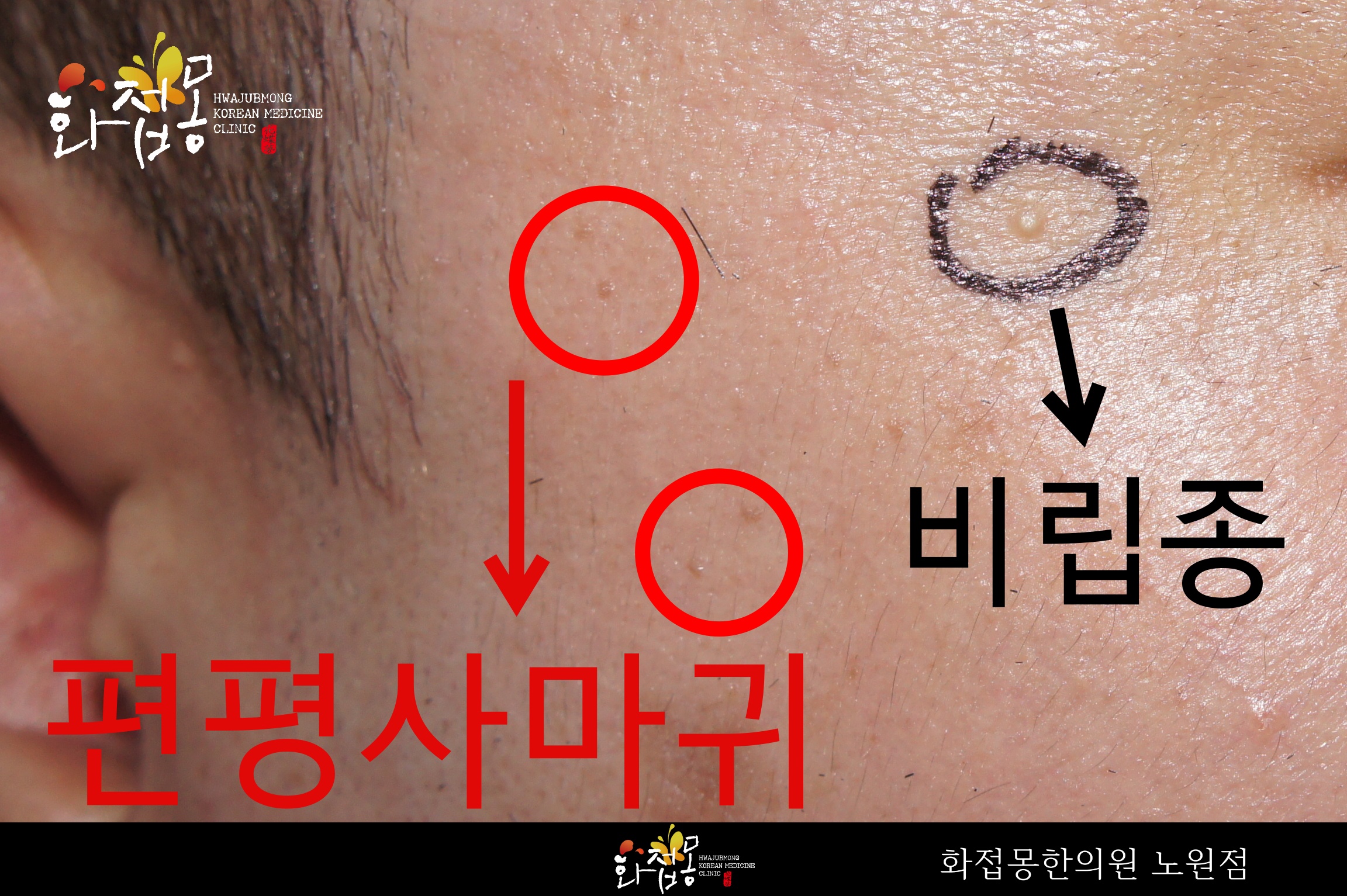 노원 화접몽한의원에서 촬영한 얼굴 피부 사진으로, 편평사마귀와 비립종의 위치를 화살표로 구분해 표시한 모습